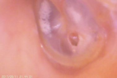 فيديو الأذن والأنف C amera منظار الأذن الرقمي لتثقيب الغشاء الطبلي