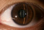 3.5 &quot;معدات تشخيص أمراض العيون لمرض السكري الجلوكوما