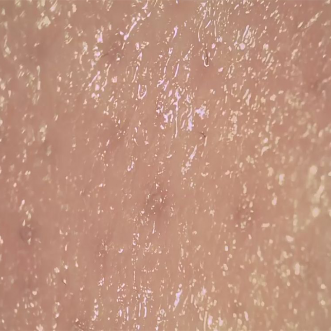 محلل رطوبة الجلد للكشف عن الجلد لاسلكي رقمي لمراقبة سطح الجلد المسام ديرم