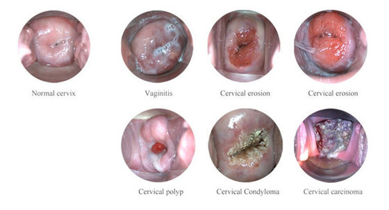 منظار المهبل الإلكتروني الرقمي المحمول