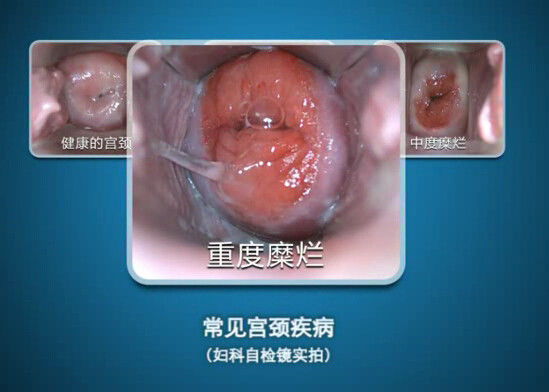 فحص التنظير المهبلي الذاتي منظار المهبل مع نطاق المراقبة 70 ~ 100 مم