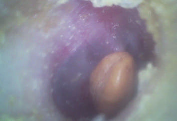 منظار الأذن بالفيديو الرقمي المحمول منظار الأذن والأنف والحنجرة مع بطاقة فلاش مايكرو إس دي 32 جيجا